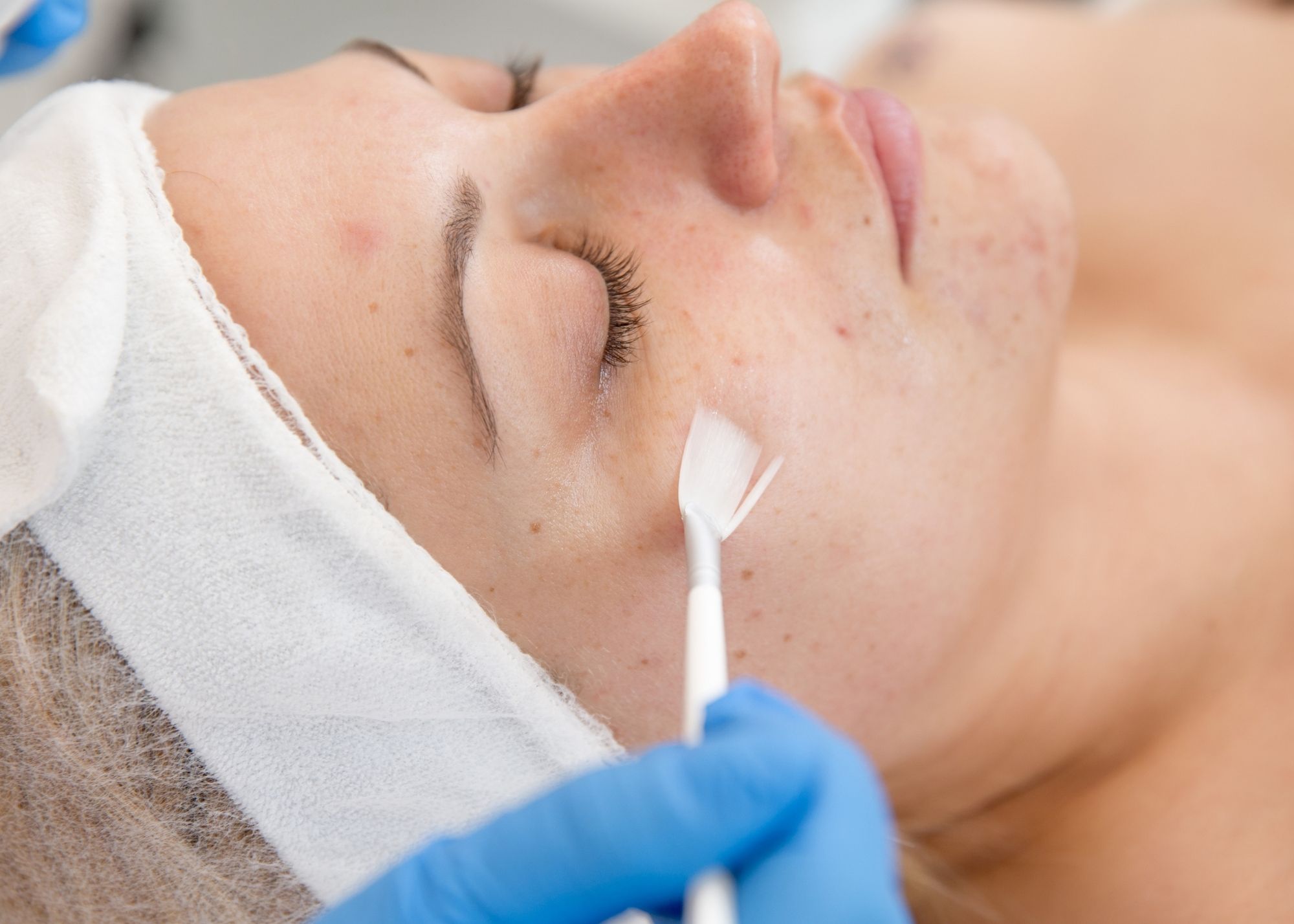 chemical peel lancaster pa